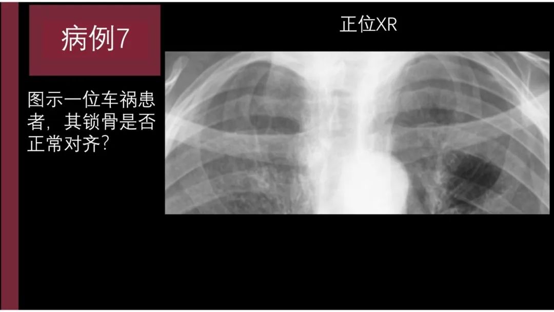 影像PPT - 【PPT】胸骨与胸锁关节-21
