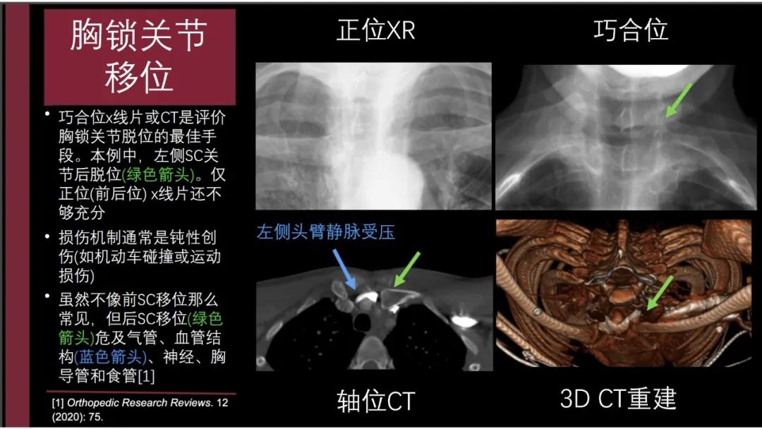 影像PPT - 【PPT】胸骨与胸锁关节-22