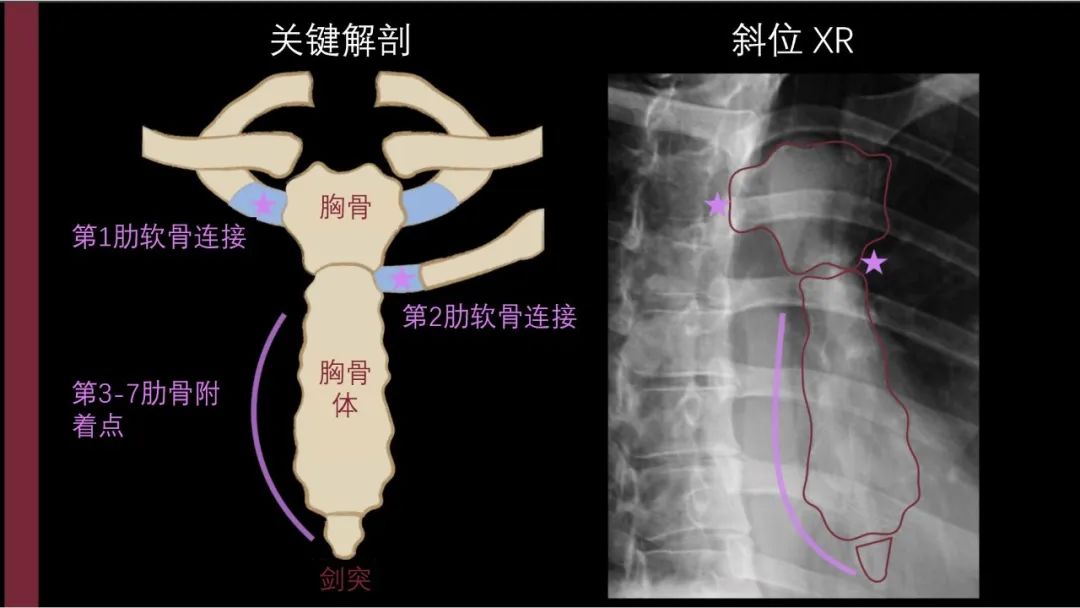 影像PPT - 【PPT】胸骨与胸锁关节-3