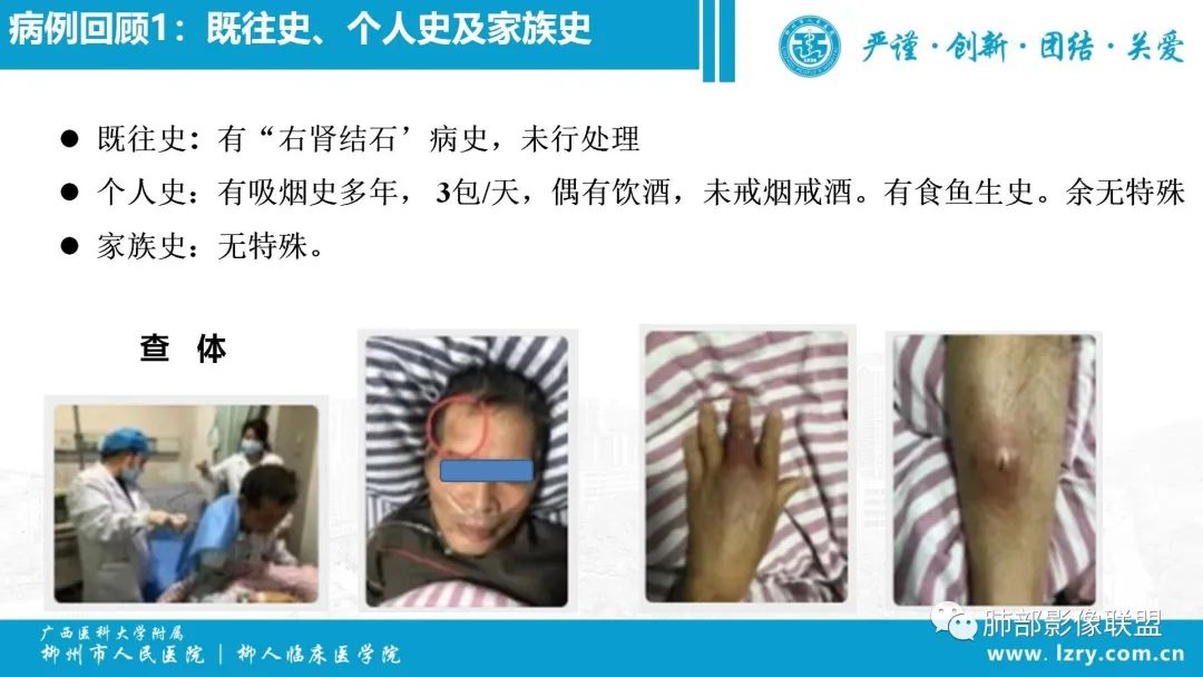 影像PPT - 【PPT】 高毒力肺炎克雷伯杆菌感染的特点-5 影像PPT - 【PPT】 高毒力肺炎克雷伯杆菌感染的特点-5