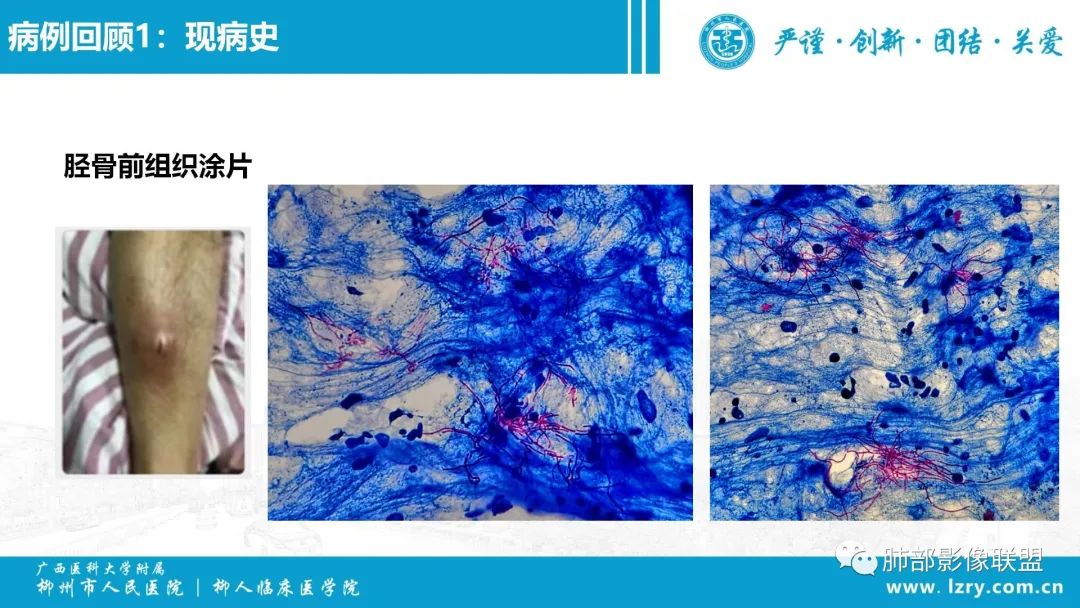 影像PPT - 【PPT】 高毒力肺炎克雷伯杆菌感染的特点-9 影像PPT - 【PPT】 高毒力肺炎克雷伯杆菌感染的特点-9