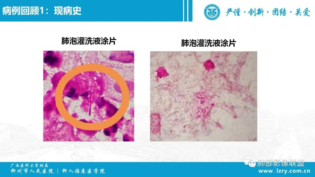 影像PPT - 【PPT】 高毒力肺炎克雷伯杆菌感染的特点-10 影像PPT - 【PPT】 高毒力肺炎克雷伯杆菌感染的特点-10