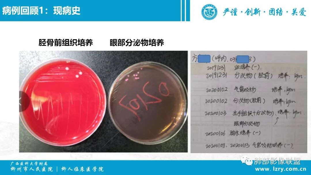 影像PPT - 【PPT】 高毒力肺炎克雷伯杆菌感染的特点-11 影像PPT - 【PPT】 高毒力肺炎克雷伯杆菌感染的特点-11