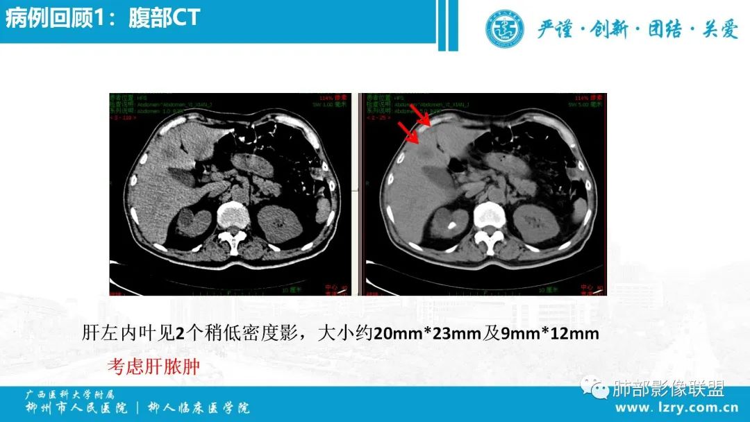 影像PPT - 【PPT】 高毒力肺炎克雷伯杆菌感染的特点-12 影像PPT - 【PPT】 高毒力肺炎克雷伯杆菌感染的特点-12