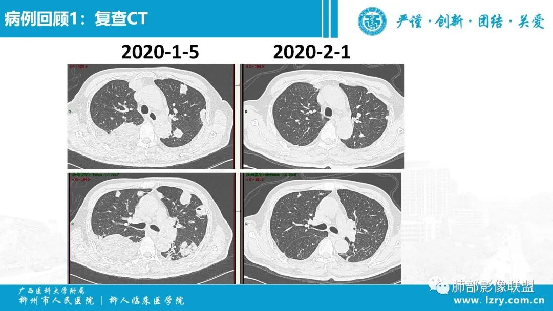 影像PPT - 【PPT】 高毒力肺炎克雷伯杆菌感染的特点-15 影像PPT - 【PPT】 高毒力肺炎克雷伯杆菌感染的特点-15