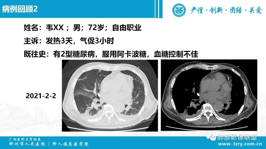 影像PPT - 【PPT】 高毒力肺炎克雷伯杆菌感染的特点-18 影像PPT - 【PPT】 高毒力肺炎克雷伯杆菌感染的特点-18