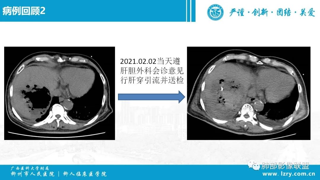 影像PPT - 【PPT】 高毒力肺炎克雷伯杆菌感染的特点-19 影像PPT - 【PPT】 高毒力肺炎克雷伯杆菌感染的特点-19