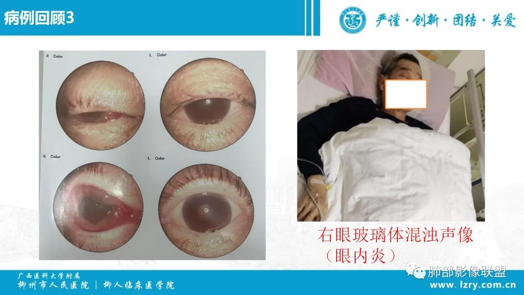 影像PPT - 【PPT】 高毒力肺炎克雷伯杆菌感染的特点-24 影像PPT - 【PPT】 高毒力肺炎克雷伯杆菌感染的特点-24
