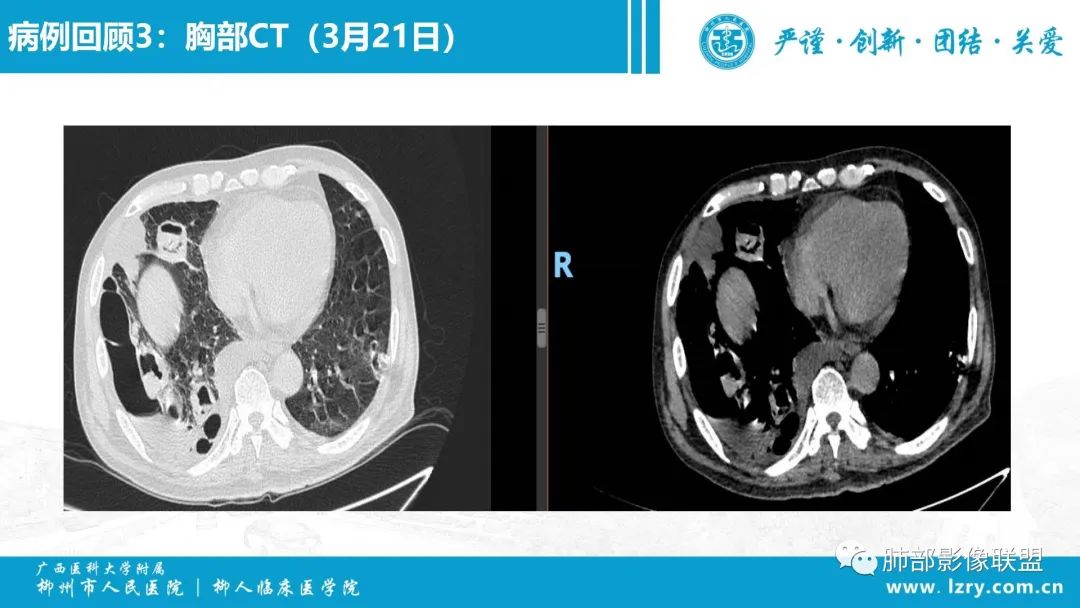 影像PPT - 【PPT】 高毒力肺炎克雷伯杆菌感染的特点-25 影像PPT - 【PPT】 高毒力肺炎克雷伯杆菌感染的特点-25