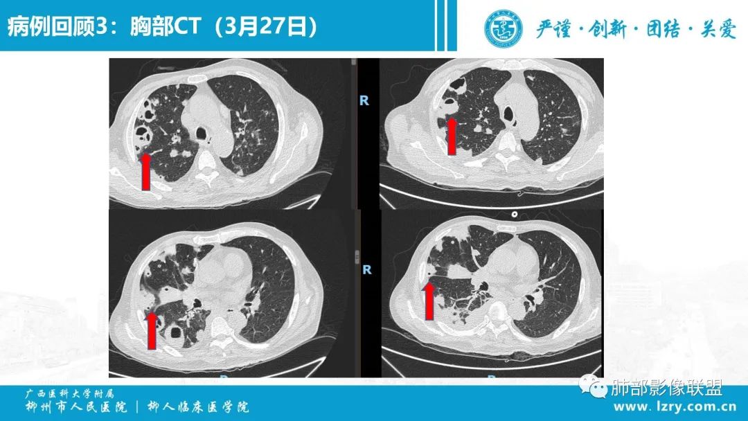 影像PPT - 【PPT】 高毒力肺炎克雷伯杆菌感染的特点-28 影像PPT - 【PPT】 高毒力肺炎克雷伯杆菌感染的特点-28