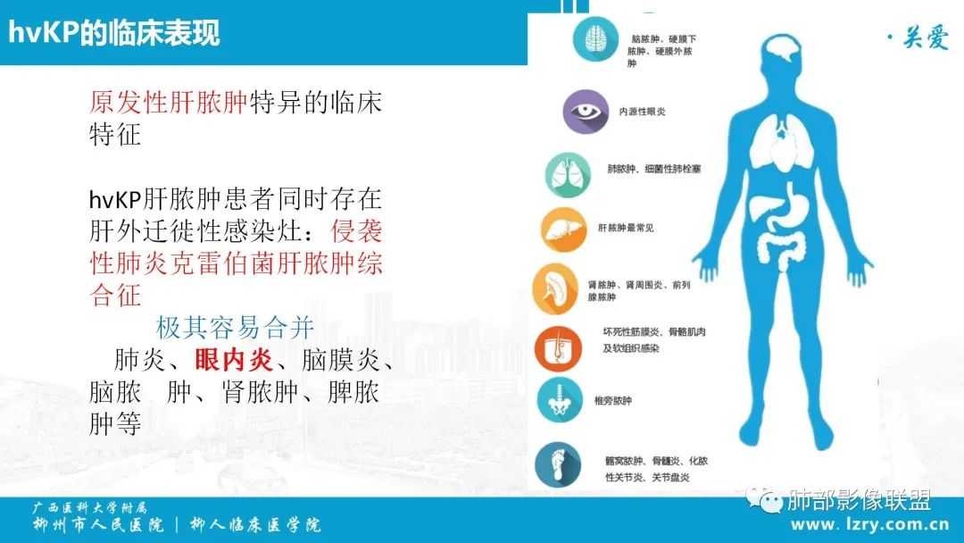 影像PPT - 【PPT】 高毒力肺炎克雷伯杆菌感染的特点-36 影像PPT - 【PPT】 高毒力肺炎克雷伯杆菌感染的特点-36