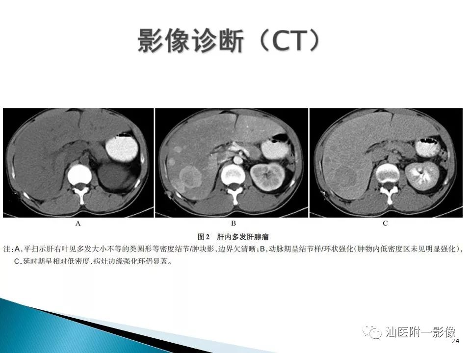 影像PPT - 【PPT】肝腺瘤再认识-24
