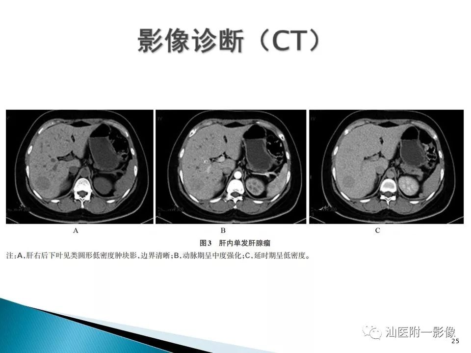 影像PPT - 【PPT】肝腺瘤再认识-25