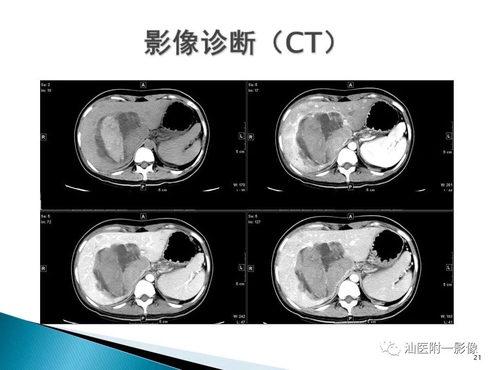 影像PPT - 【PPT】肝腺瘤再认识-21