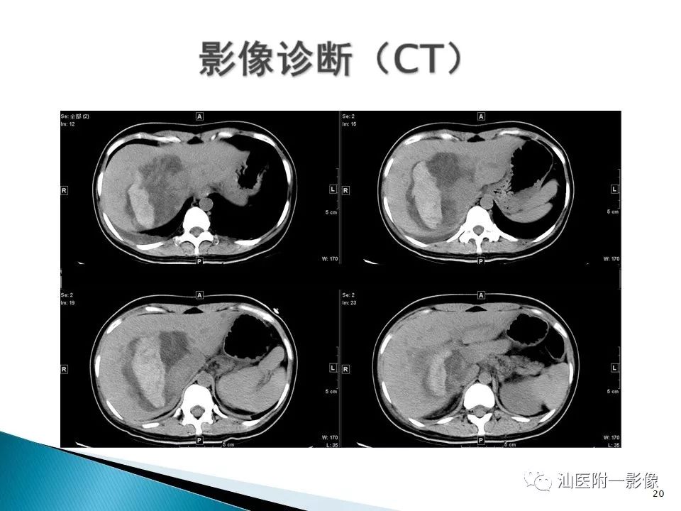 影像PPT - 【PPT】肝腺瘤再认识-20