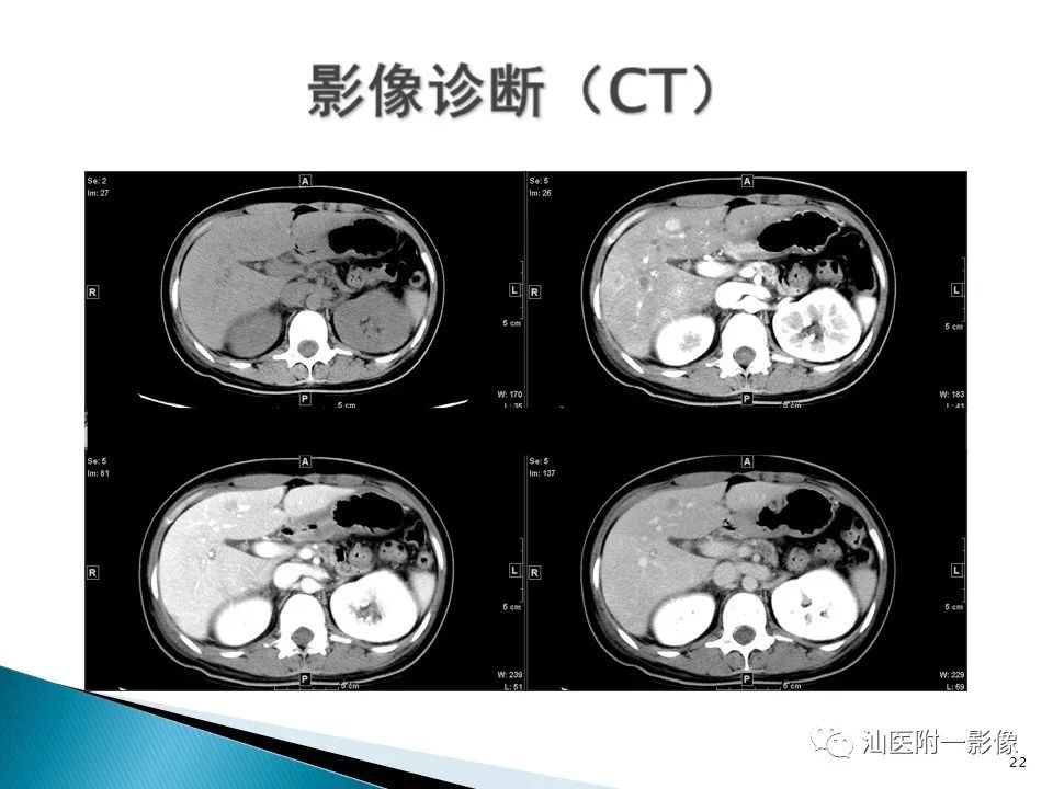 影像PPT - 【PPT】肝腺瘤再认识-22