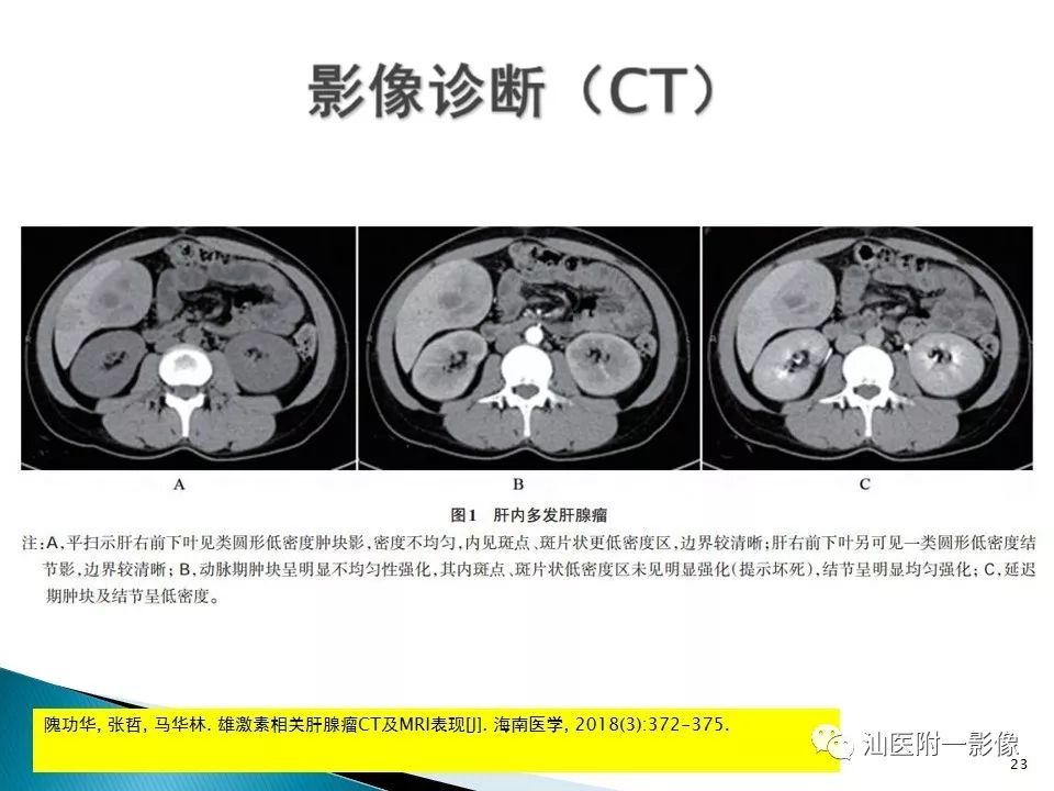 影像PPT - 【PPT】肝腺瘤再认识-23