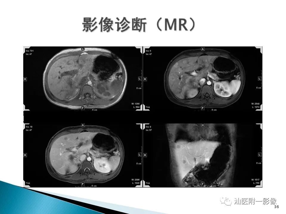 影像PPT - 【PPT】肝腺瘤再认识-36