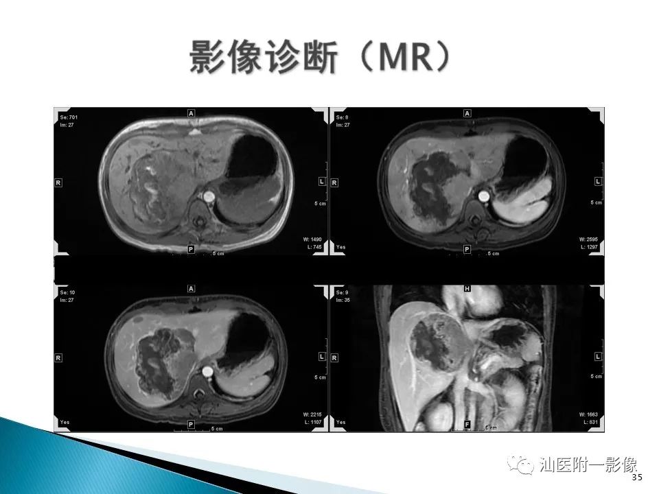 影像PPT - 【PPT】肝腺瘤再认识-35