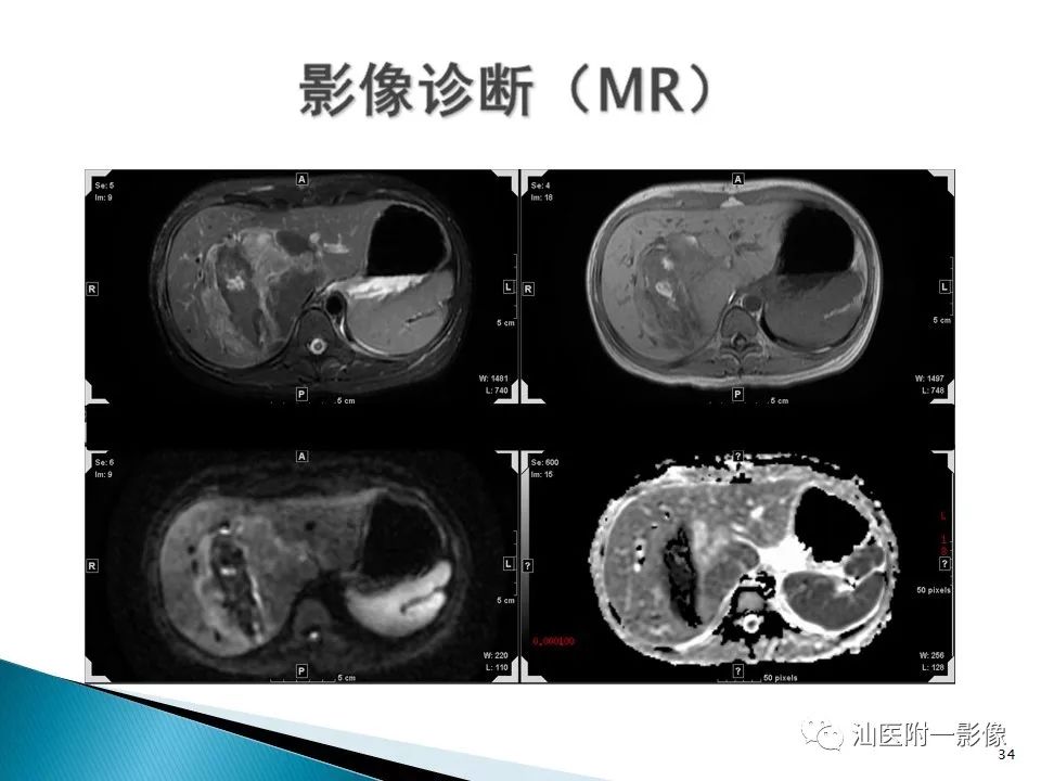 影像PPT - 【PPT】肝腺瘤再认识-34