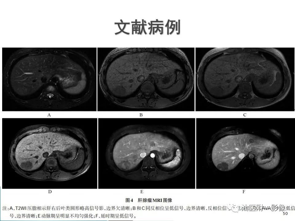 影像PPT - 【PPT】肝腺瘤再认识-50
