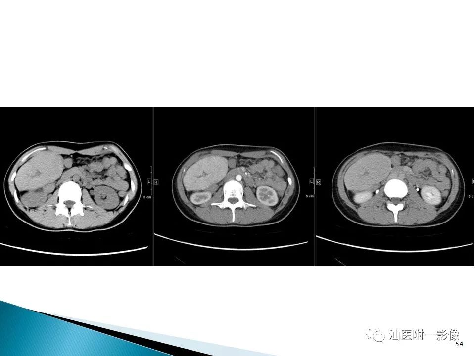 影像PPT - 【PPT】肝腺瘤再认识-54