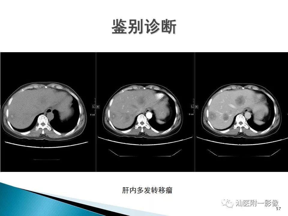 影像PPT - 【PPT】肝腺瘤再认识-57