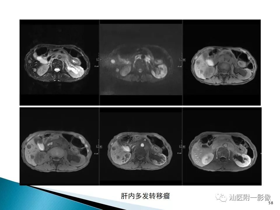 影像PPT - 【PPT】肝腺瘤再认识-58