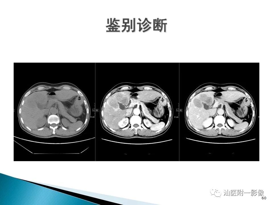 影像PPT - 【PPT】肝腺瘤再认识-60