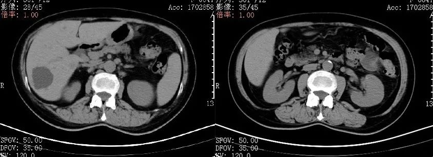影像PPT - 【病例】结节病1例PET/CT影像-18 影像PPT - 【病例】结节病1例PET/CT影像-18