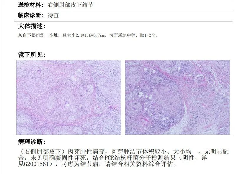 影像PPT - 【病例】结节病1例PET/CT影像-19 影像PPT - 【病例】结节病1例PET/CT影像-19