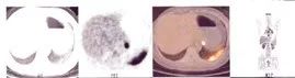 影像PPT - 【病例】结节病1例PET/CT影像-22 影像PPT - 【病例】结节病1例PET/CT影像-22