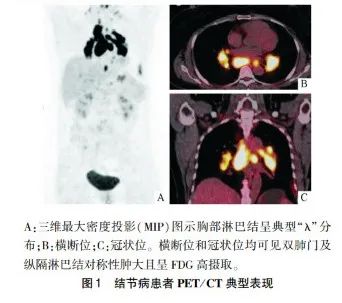影像PPT - 【病例】结节病1例PET/CT影像-24 影像PPT - 【病例】结节病1例PET/CT影像-24