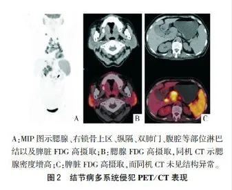 影像PPT - 【病例】结节病1例PET/CT影像-25 影像PPT - 【病例】结节病1例PET/CT影像-25