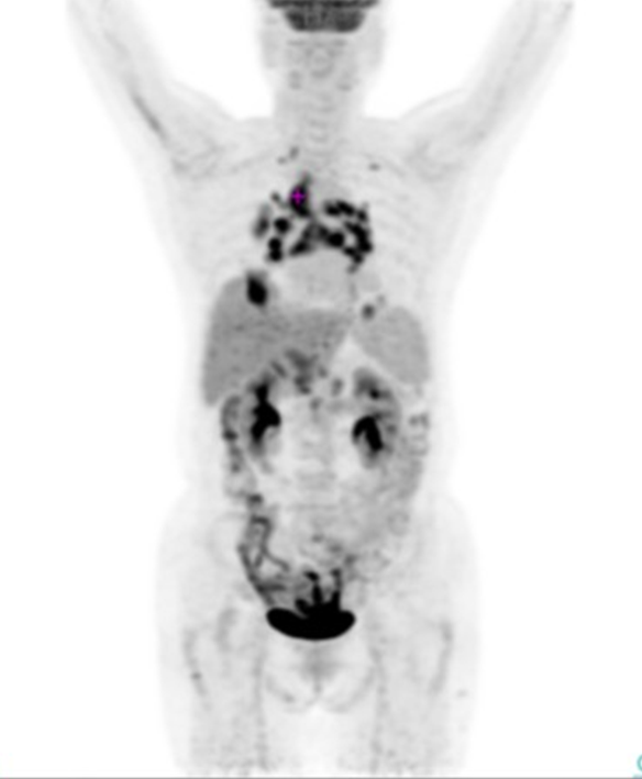 影像PPT - 【病例】结节病1例PET/CT影像-2 影像PPT - 【病例】结节病1例PET/CT影像-2