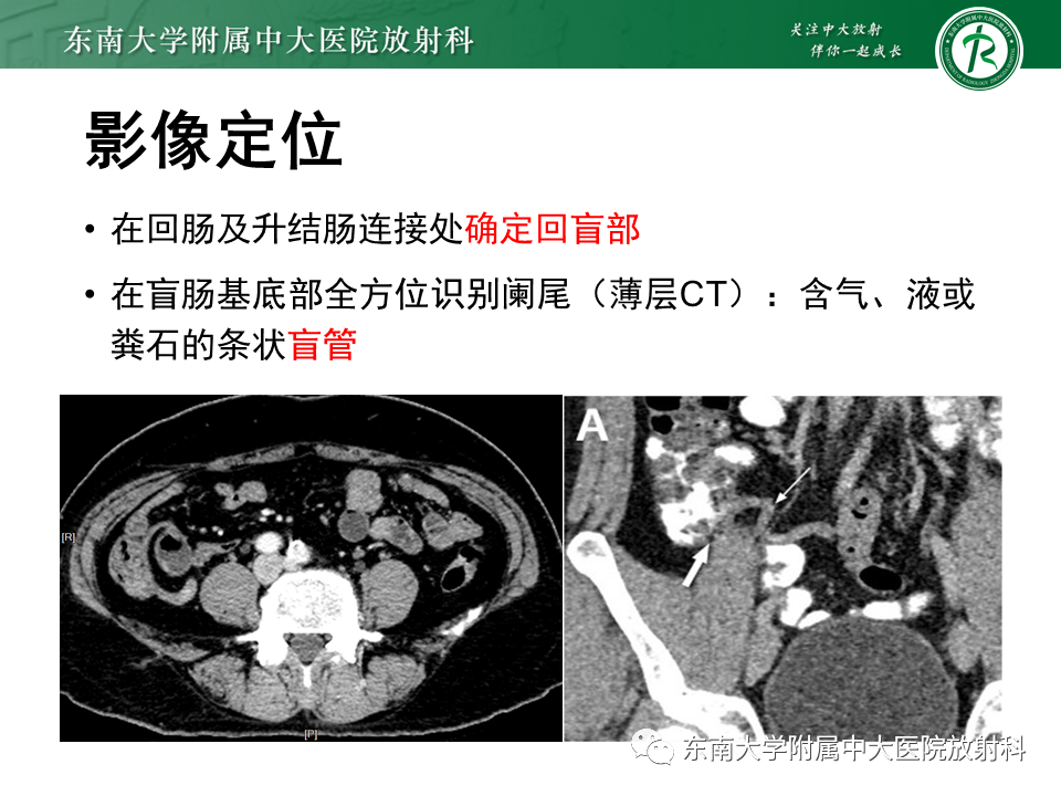 影像PPT - 【PPT】阑尾炎的CT诊断-8