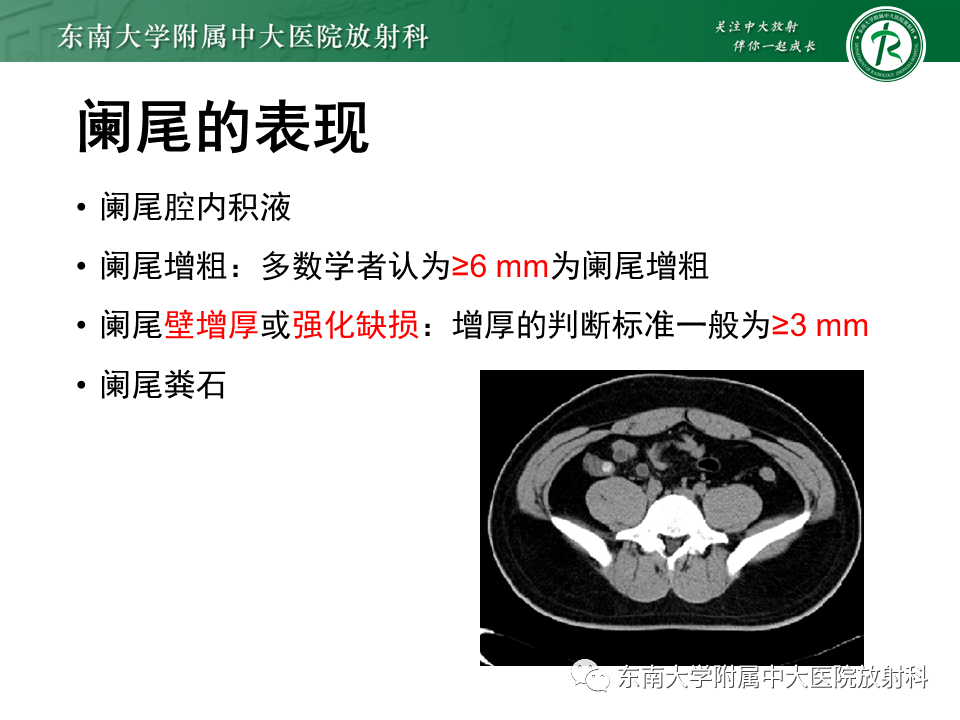 影像PPT - 【PPT】阑尾炎的CT诊断-14