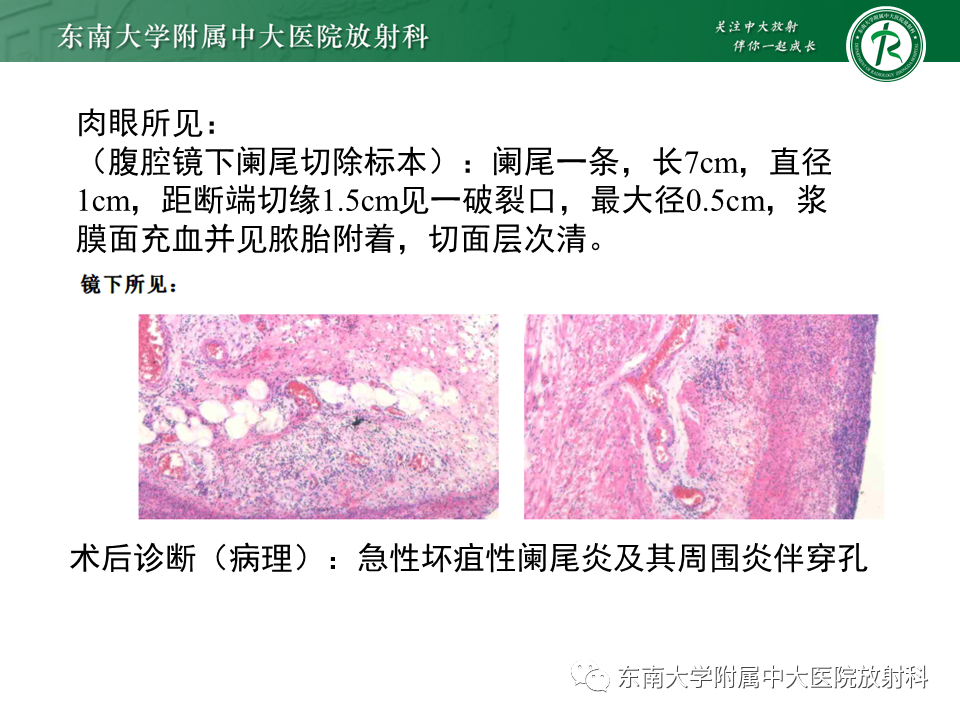 影像PPT - 【PPT】阑尾炎的CT诊断-3