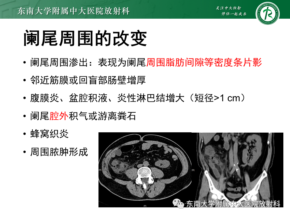 影像PPT - 【PPT】阑尾炎的CT诊断-15