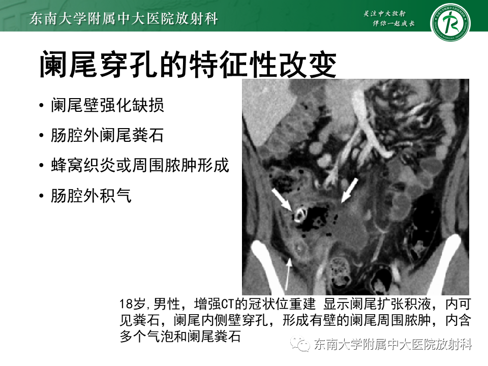 影像PPT - 【PPT】阑尾炎的CT诊断-16