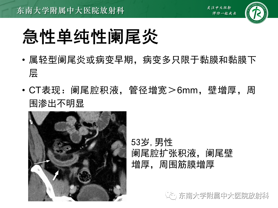 影像PPT - 【PPT】阑尾炎的CT诊断-17