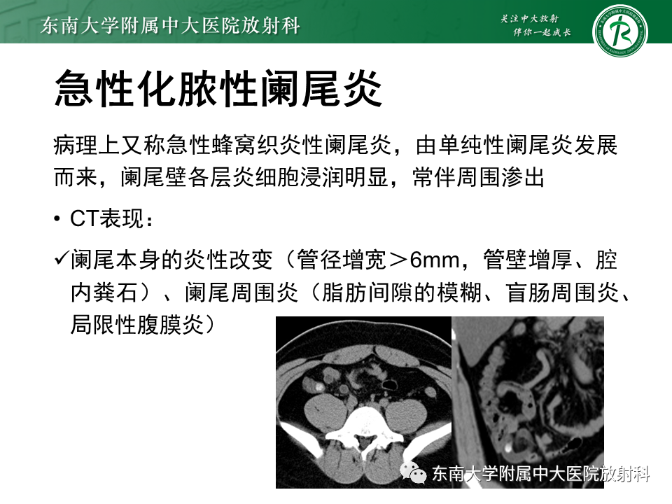 影像PPT - 【PPT】阑尾炎的CT诊断-18