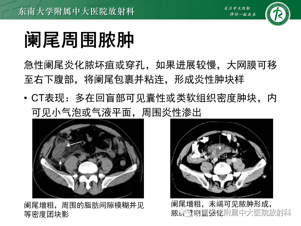 影像PPT - 【PPT】阑尾炎的CT诊断-20