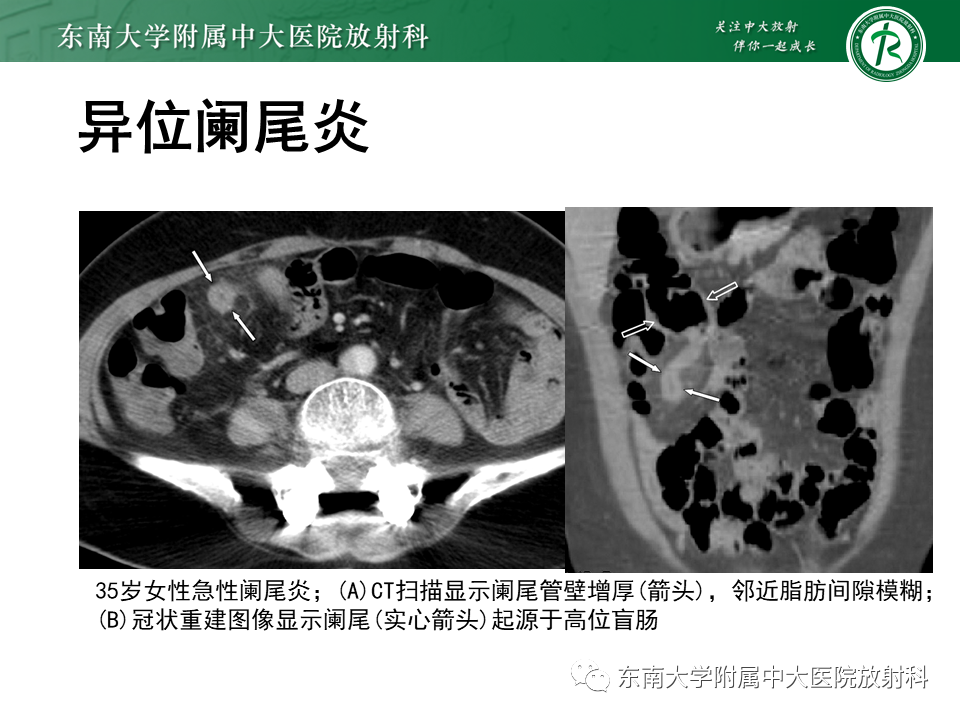 影像PPT - 【PPT】阑尾炎的CT诊断-23