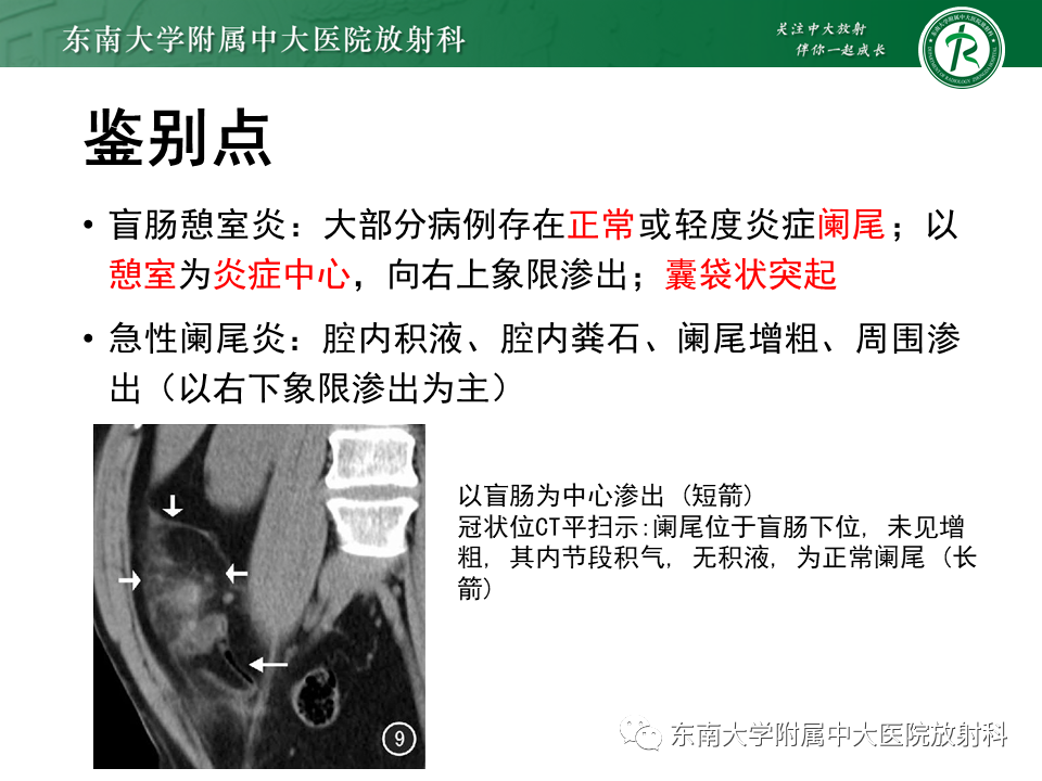 影像PPT - 【PPT】阑尾炎的CT诊断-26