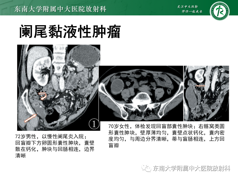 影像PPT - 【PPT】阑尾炎的CT诊断-28