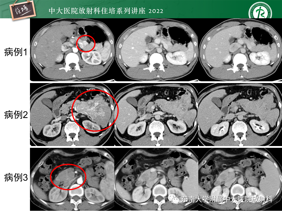 影像PPT - 【PPT】胰腺神经内分泌肿瘤的影像诊断及鉴别-2