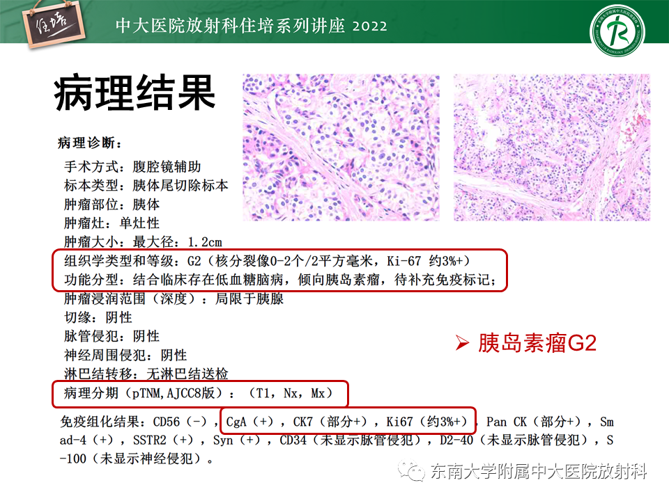 影像PPT - 【PPT】胰腺神经内分泌肿瘤的影像诊断及鉴别-15