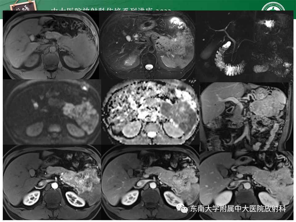 影像PPT - 【PPT】胰腺神经内分泌肿瘤的影像诊断及鉴别-24