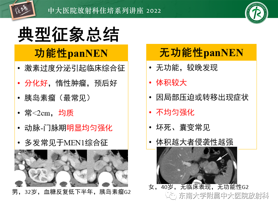 影像PPT - 【PPT】胰腺神经内分泌肿瘤的影像诊断及鉴别-34